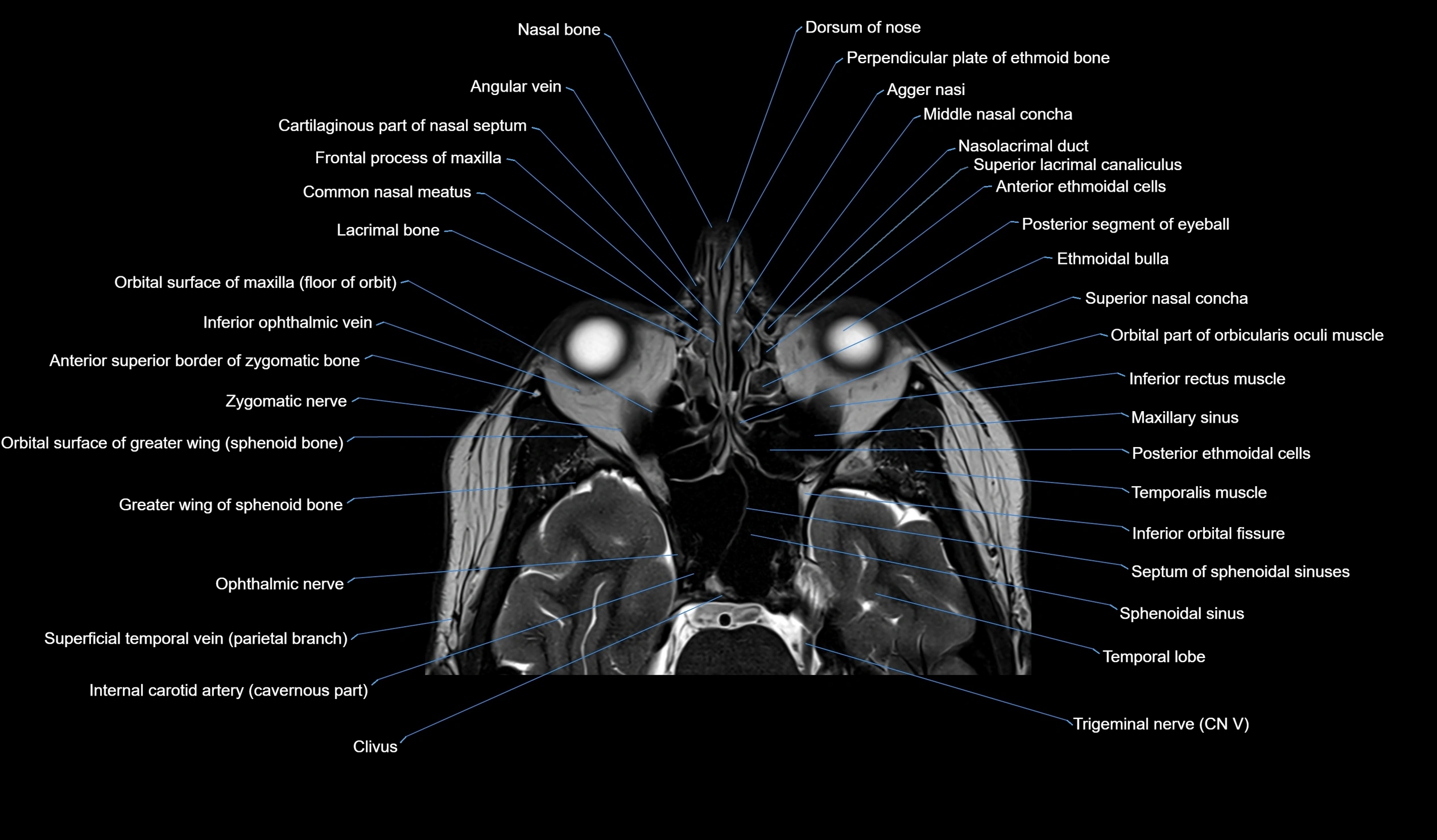 MRI face & paranasal sinuses(PNS) labelled  coronal  cross sectional anatomy 3T radiology  image-img-00001-00018.webp